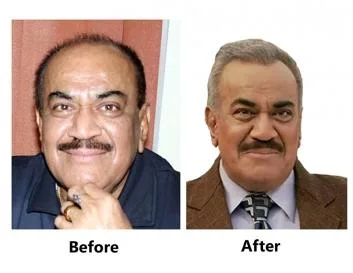hair transplant in mumbai