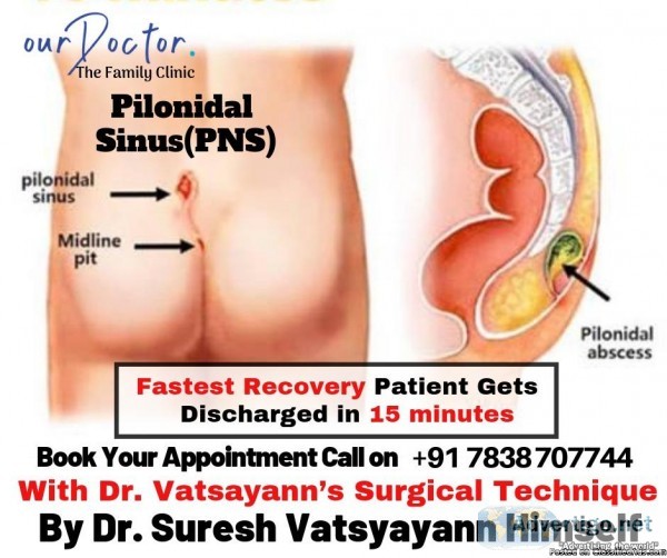 Pilonidal Sinus Surgery in Gurgaon and Delhi NCR