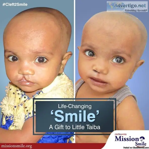 Mission smile- Cleft palate surgery in India