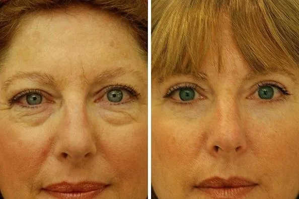 Eyelids surgery Miami - Dr. Ramirez Plastic Surgeon