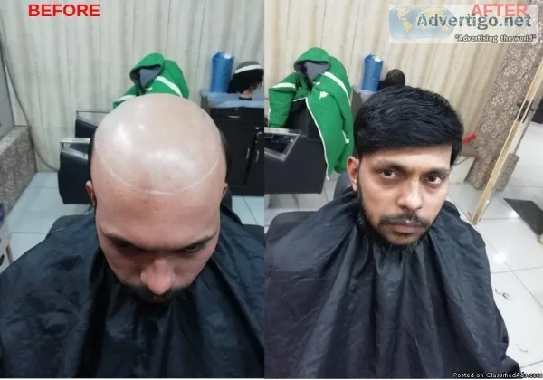Permanent Hair Removal with Laser