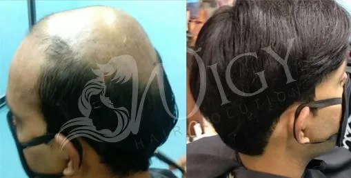 Non surgical hair replacement