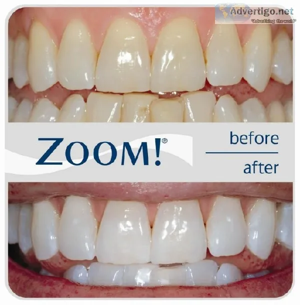 Philip Zoom LED Whitening is here 
