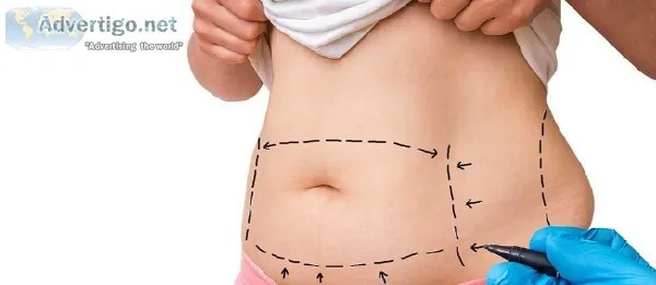 Get Rid Of Your Stubborn Fats. Get This Liposuction Surgery in M