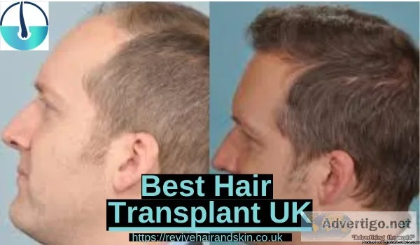Hair Transplant In UK - Revive Hair and Skin Clinic