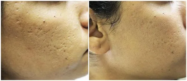 Get Microneedling Treatment in Honolulu  Hawaii