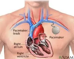 Find Pacemaker Surgery Cost at Top Hospital in Delhi - Crediheal