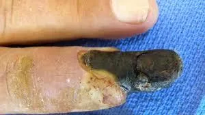 Best Gangrene Treatment In Jaipur