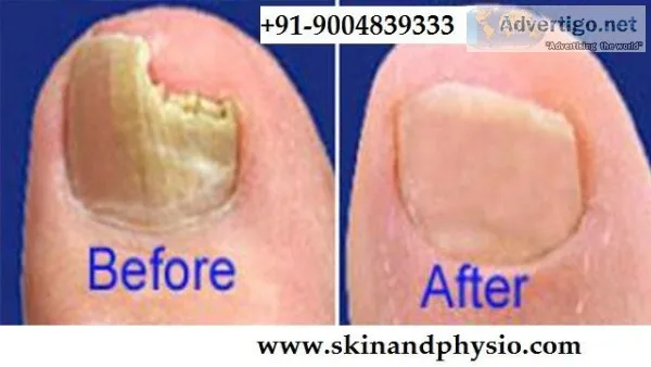 BEST TREATMENT FOR NAIL INFECTION