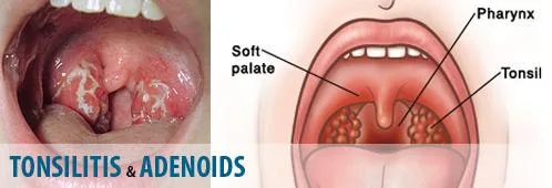 6 Best Homeopathic Medicines for Tonsillitis Treatment