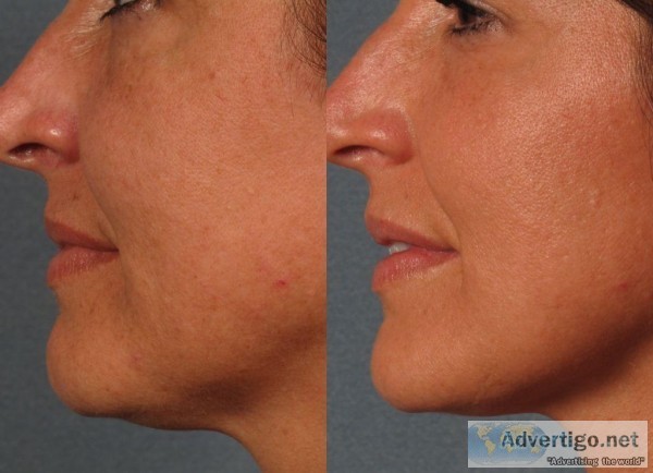 Vitality Spa Skin tightening treatment Boca Raton