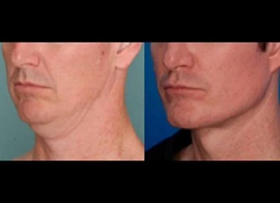 Best neck lift surgeon Miami - Dr. Ramirez Plastic Surgeon