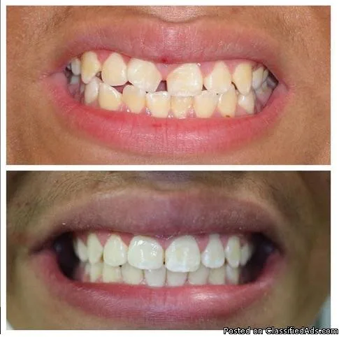 Invisalign Park Ridge IL  Loukas Denistry