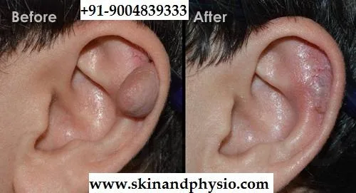 BEST TREATMENT FOR KELOID