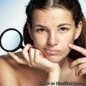 Acne Treatment in Gurgaon