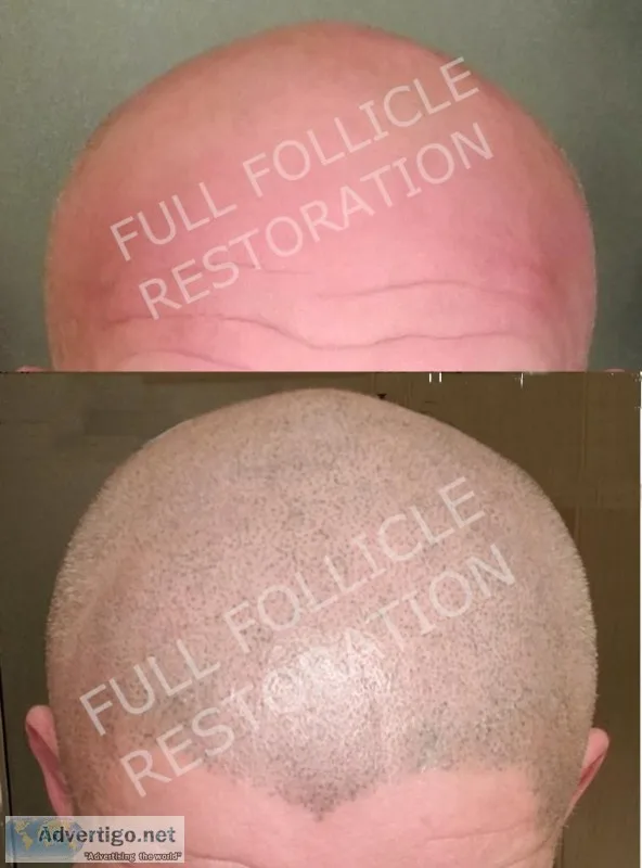 Scalp Micro-Pigmentation (Hair replacement)