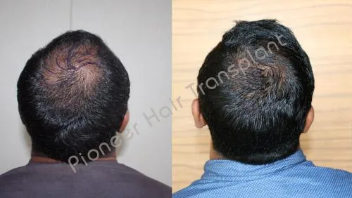 Hair Fall Treatment in Bangalore