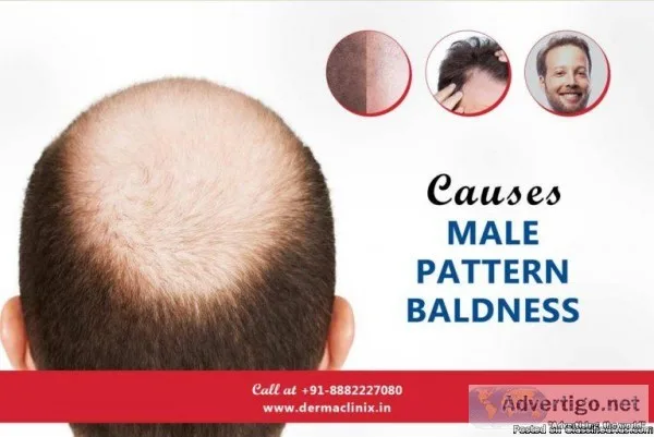 Are You Facing Baldness Get The Best Treatment for This Concern 