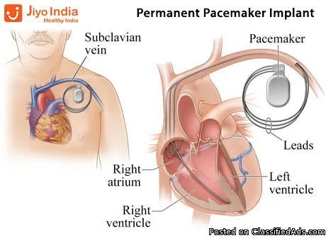 PPI-Permanent Pacemaker Implant - Double Chamber Cost in India