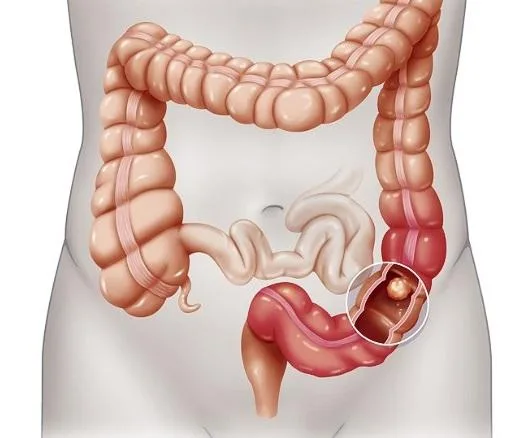 Signs Symptoms and Precautions for piles
