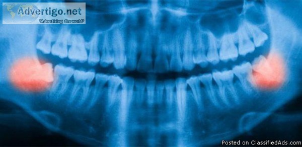 All You Need to Know About Wisdom Teeth