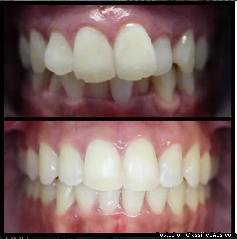 Park Ridge Invisalign  Loukas Dentistry