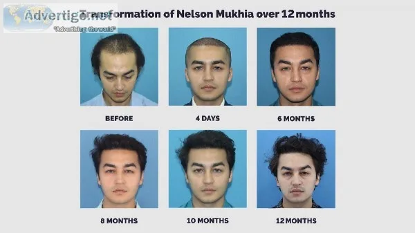Hair Transplant in Mumbai