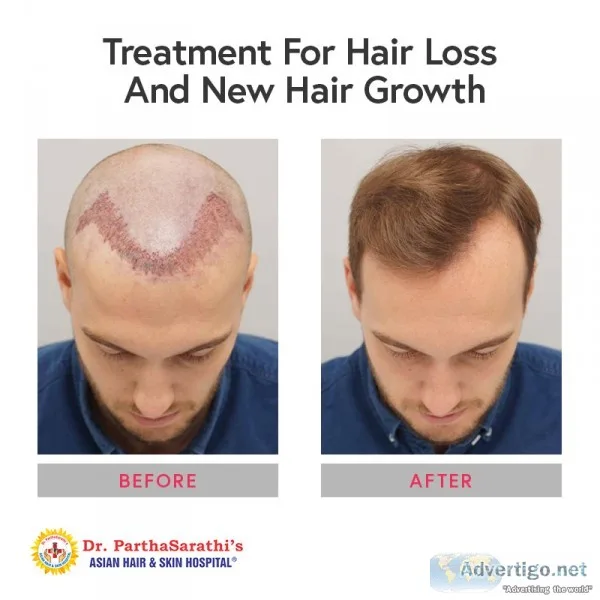 Best Hair Transplant Clinic in Bangalore