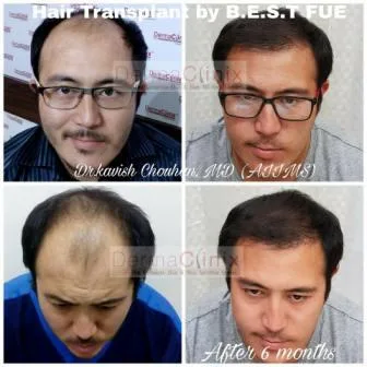 Hair Transplant &ndash A Viable and Affordable Treatment Alterna