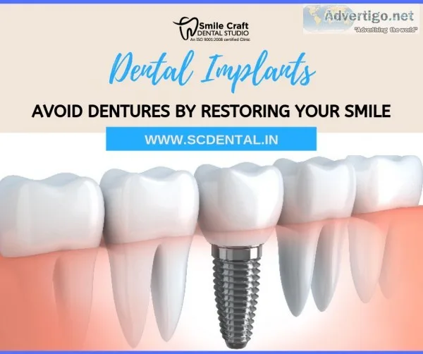 Benefits of Dental Implants - scdental
