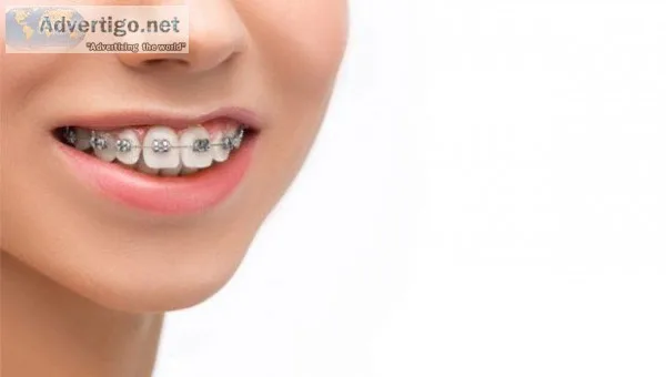 All About Braces