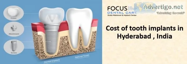 Dental Implants Clinic in Madinaguda(Miyapur)