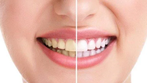 Best Teeth Whitening Clinic In Gurgaon - Punyam Dental