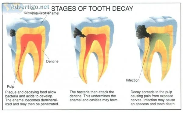 Root Canal Treatment in Gurgaon