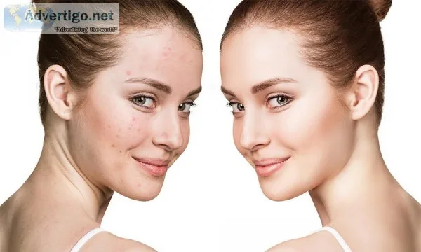 Acne Scar Treatment in Delhi