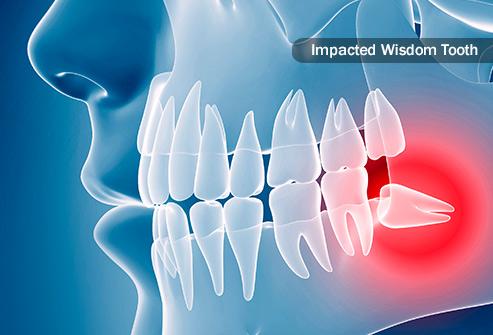 Wisdom Teeth Process- BEDC