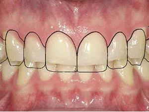 Finding The Removal denture in kolkata  and Replace Your Denture