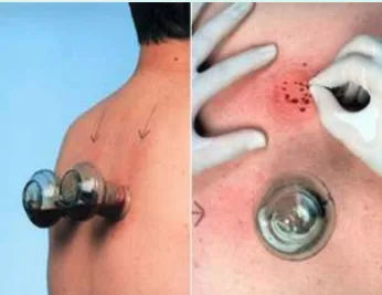 hijama treatment in chennai