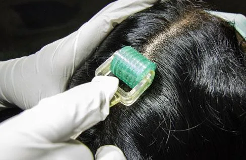 hair fall treatment in chennai