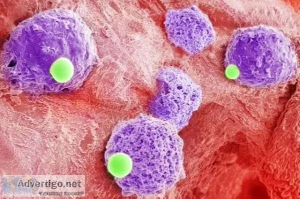 Bone Marrow Transplant Surgery - RGCIRC