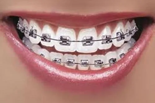 Dental Implants Treatment Mulund