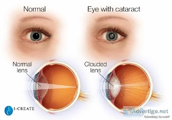 Best Eye Doctor in Delhi