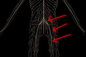 Get The Best Sciatica Pain Relief MD And Live Your Life Without 
