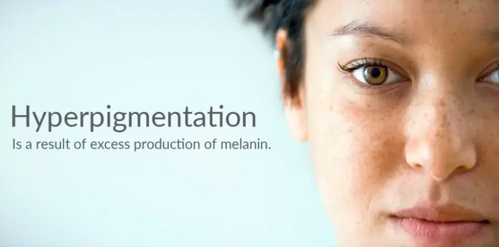 Best cream for acne hyperpigmentation