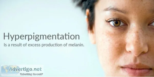Best ointment for hyperpigmentation
