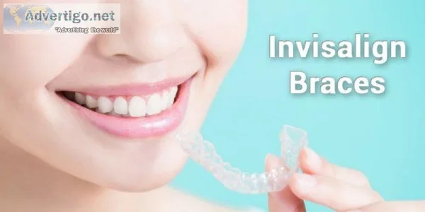 Best Invisalign Braces Treatment in Delhi &ndash Dr Bhutani Dent