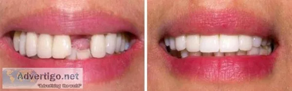 Are You Worried About Your Broken Teeth- Best Dental Implants In