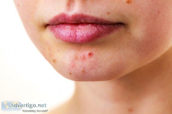 Best Acne Treatment in Gurgaon and South Delhi Saket - Royal Lus