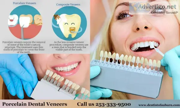 Porcelain Dental Veneers  Cosmetic dentistry Auburn WA