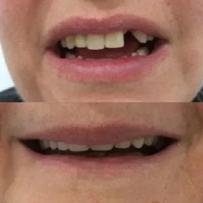 Affordable Dentures Clinic in Brisbane